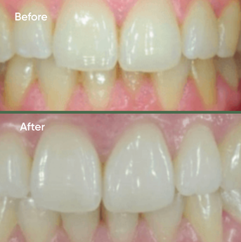Before and after dental treatment 1