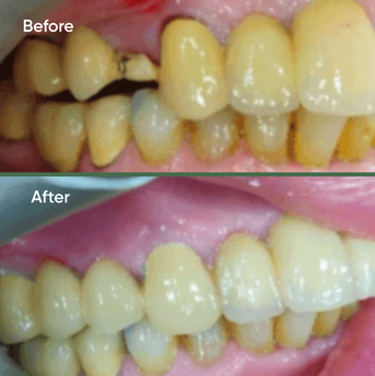 Before and after dental treatment 2