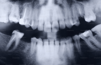 Dental X-Ray